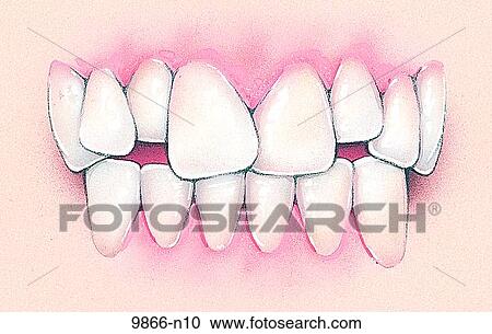 Hyperdontia Unlabeled View Large Illustration Clipart - Hyperdontia Unlabeled. Fotosearch