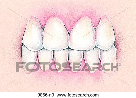 Hypodontia Unlabeled View Large Illustration Stock Illustration - Hypodontia Unlabeled. Fotosearch