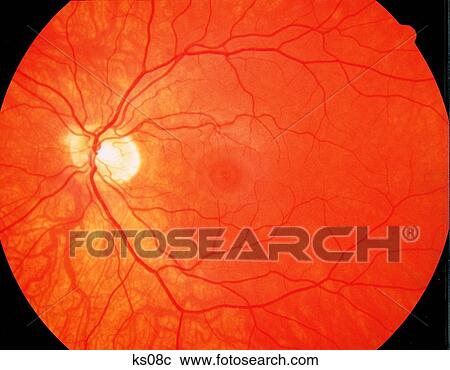 Image showing optic disk. View Large Illustration Clipart - Image showing optic disk.. Fotosearch