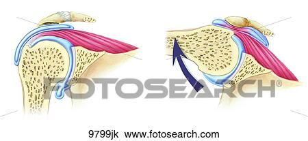 Impingement Syndrome of the Shoulder Unlabeled View Large Illustration Drawing - Impingement Syndrome of the Shoulder Unlabeled. Fotosearch