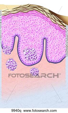 Stock Illustration - Juctional Nevus (Mole) Unlabeled. Fotosearch
