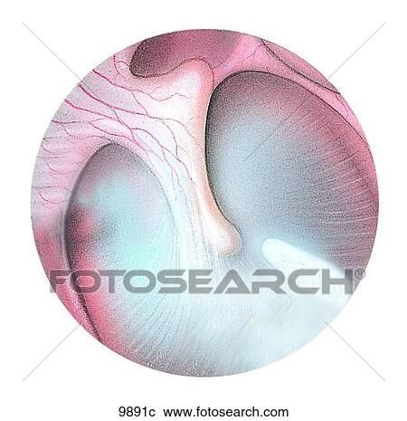 Clipart - Lateral Aspect of the Right Tympanic Membrane Unlabeled. Fotosearch