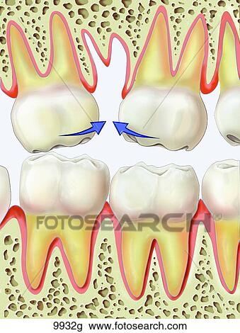 Loss of Teeth Unlabeled View Large Illustration Drawing - Loss of Teeth Unlabeled. Fotosearch