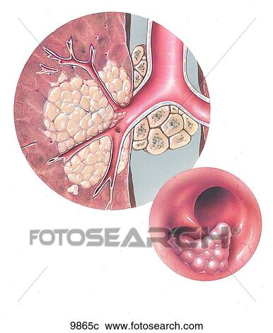 Clipart - Lung Cancer Bronchoscopic View Unlabeled. Fotosearch