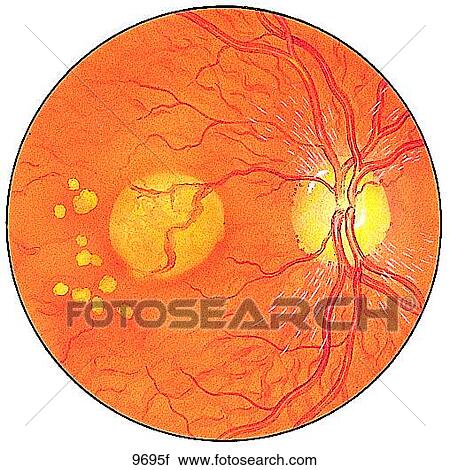 Macular Degeneration Unlabeled View Large Illustration Clip Art - Macular Degeneration Unlabeled. Fotosearch