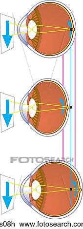 Drawing - Normal, farsighted and nearsighted eyes.. Fotosearch