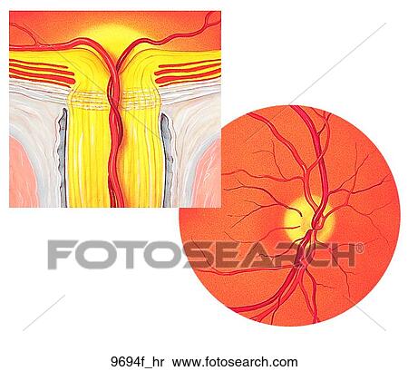 Stock Illustration - Optic Nerve (Cross-Section) and Fundus Unlabeled. Fotosearch