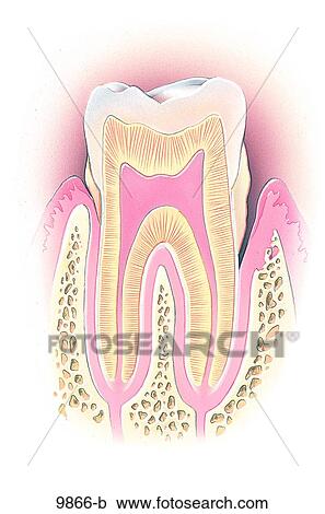Clipart - Periodonatal Disease Unlabeled. Fotosearch