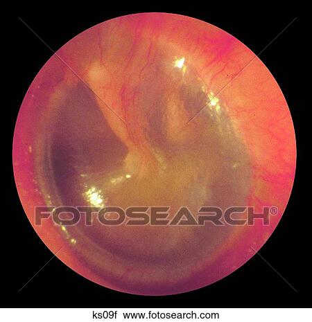Photo of eardrum. View Large Illustration Clip Art - Photo of eardrum.. Fotosearch