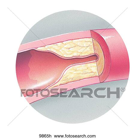 Drawing - Plaque in Coronary Artery Wall Unlabeled. Fotosearch