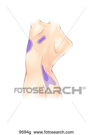 Drawing - Posterior Torso Referred Pain: Serratus to Ilioposas Unlabeled. Fotosearch