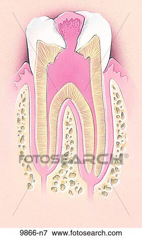 Pulp Polyp Unlabeled View Large Illustration Stock Illustration - Pulp Polyp Unlabeled. Fotosearch