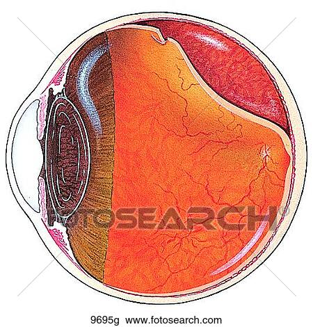 Retinal Tear and Detachment Unlabeled View Large Illustration Drawing - Retinal Tear and Detachment Unlabeled. Fotosearch