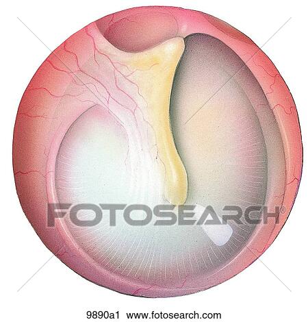 Clip Art - Right Tympanic Membrane Unlabeled. Fotosearch