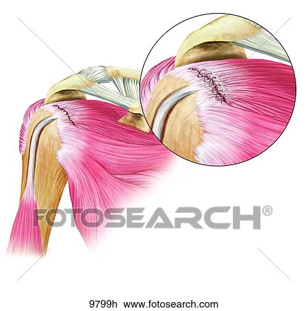 Rotator Cuff Tear Unlabeled View Large Illustration Drawing - Rotator Cuff Tear Unlabeled. Fotosearch