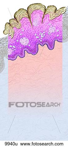 Seborrheic Keratosis (Basal Cell Papilloma) Unlabeled View Large Illustration Stock Illustration - Seborrheic Keratosis (Basal Cell Papilloma) Unlabeled. Fotosearch