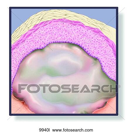 Skin Bulla Unlabeled View Large Illustration Drawing - Skin Bulla Unlabeled. Fotosearch