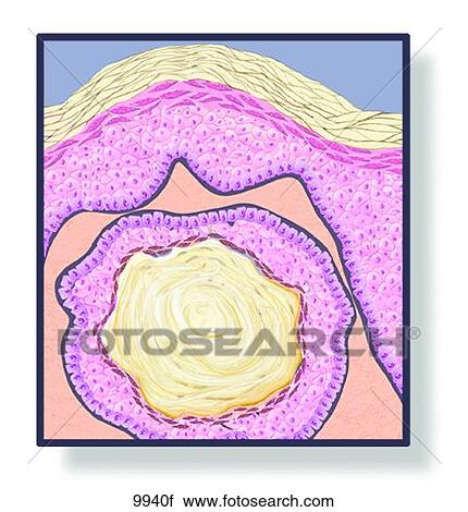 Skin Cyst Unlabeled View Large Illustration Clip Art - Skin Cyst Unlabeled. Fotosearch