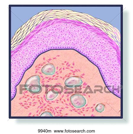 Skin Nodule Unlabeled View Large Illustration Stock Illustration - Skin Nodule Unlabeled. Fotosearch