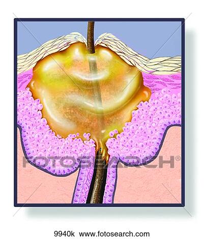 Skin Pustule Unlabeled View Large Illustration Drawing - Skin Pustule Unlabeled. Fotosearch