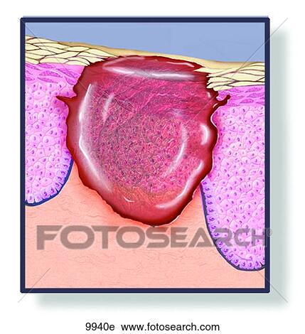 Skin Ulcer Unlabeled View Large Illustration Clip Art - Skin Ulcer Unlabeled. Fotosearch