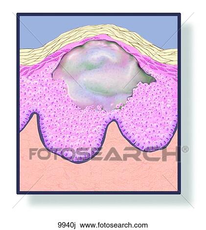 Skin Vesicle Unlabeled View Large Illustration Drawing - Skin Vesicle Unlabeled. Fotosearch