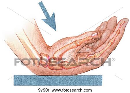 Smith's Fracture Unlabeled View Large Illustration Stock Illustration - Smith's Fracture Unlabeled. Fotosearch