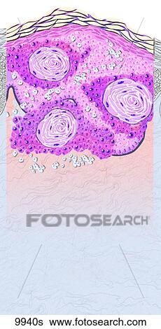 Squamous Cell Carcinoma Unlabeled View Large Illustration Stock Illustration - Squamous Cell Carcinoma Unlabeled. Fotosearch