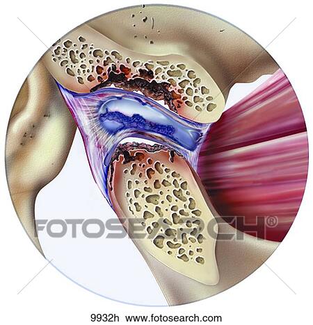 Drawing - Systemic Diseases Causing TMJ Damage and Inflammation Unlabeled. Fotosearch