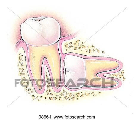 Drawing - Teeth Impaction Horizontal Unlabeled. Fotosearch