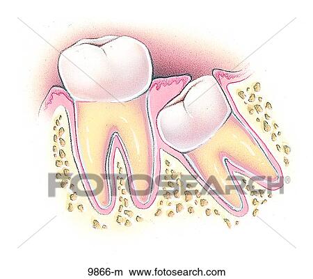 Teeth Impaction Mesioangular Unlabeled View Large Illustration Stock Illustration - Teeth Impaction Mesioangular Unlabeled. Fotosearch
