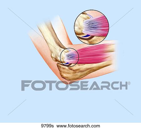 Stock Illustration - Tennis Elbow Unlabeled. Fotosearch