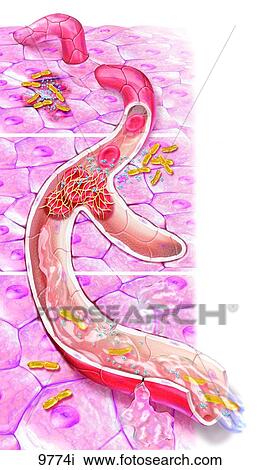Three Ways Bacteria Cause Damage to the Body Unlabeled View Large Illustration Drawing - Three Ways Bacteria Cause Damage to the Body Unlabeled. Fotosearch