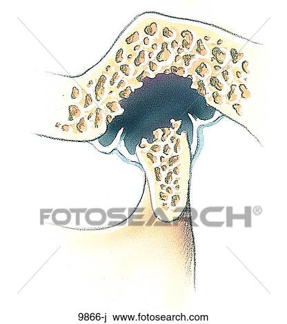 TMJ Skeletal Jaw Deteroriation From Osteoporosis Unlabeled View Large Illustration Drawing - TMJ Skeletal Jaw Deteroriation From Osteoporosis Unlabeled. Fotosearch