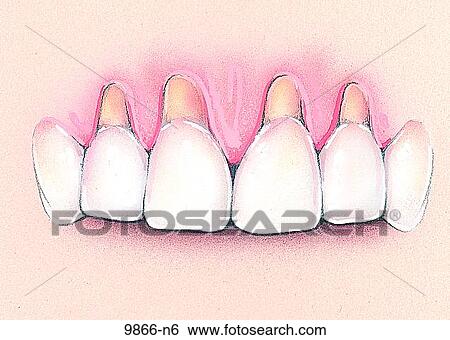 Toothbrush abrasion Unlabeled View Large Illustration Stock Illustration - Toothbrush abrasion Unlabeled. Fotosearch