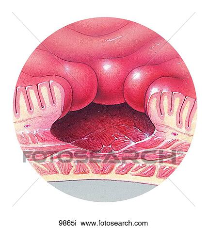 Ulcer in Lining of Stomach Unlabeled View Large Illustration Drawing - Ulcer in Lining of Stomach Unlabeled. Fotosearch