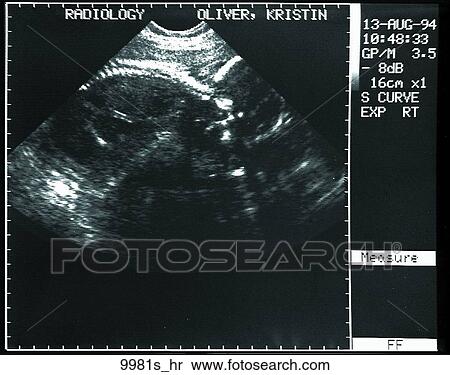 Stock Illustration - Ultrasound Unlabeled. Fotosearch