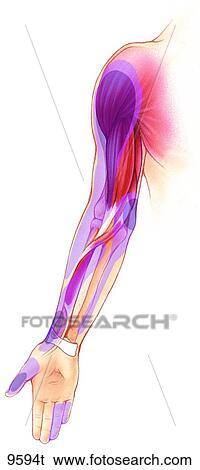 Upper Extremity Trigger Points: Infraspinatus to Flexor Pollicis Longus Unlabeled View Large Illustration Stock Illustration - Upper Extremity Trigger Points: Infraspinatus to Flexor Pollicis Longus Unlabeled. Fotosearch