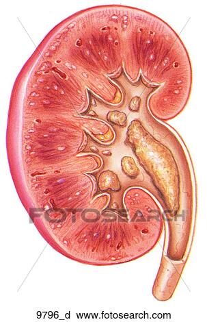 Uric Acid Stones in Kidney Unlabeled View Large Illustration Clip Art - Uric Acid Stones in Kidney Unlabeled. Fotosearch