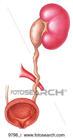 Urinary Obstruction and Stasis: Early Phase Unlabeled View Large Illustration Drawing - Urinary Obstruction and Stasis: Early Phase Unlabeled. Fotosearch