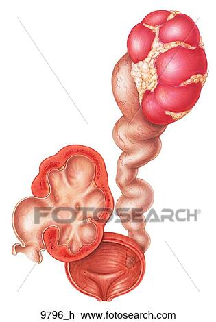 Drawing - Urinary Obstruction and Stasis: Late Phase Unlabeled. Fotosearch