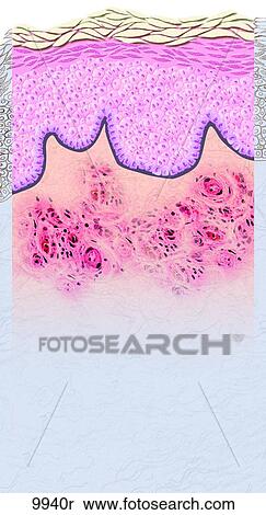 Urticaria (Hives) Unlabeled View Large Illustration Stock Illustration - Urticaria (Hives) Unlabeled. Fotosearch