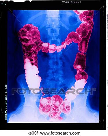 X-ray of a large intestine. View Large Illustration Clip Art - X-ray of a large intestine.. Fotosearch