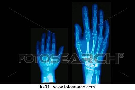 X-rays of child and adult hands. View Large Illustration Drawing - X-rays of child and adult hands.. Fotosearch