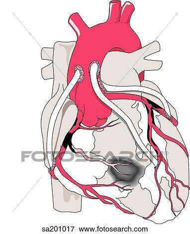 イラスト の A 完了された 冠状 バイパス どこ で に か 新しい 血 流れ 持つ ある 作成される へ 心臓 組織 によって 注意を他にそらす Channels イラスト Sa1017 Fotosearch