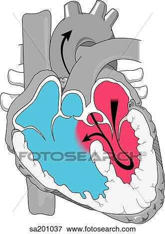 Stock Illustration - A defect in the septum between the cardiac ventricles resulting in a left to right shunt of blood.. Fotosearch