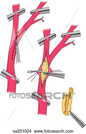 An endarterectomy where diseased endothelia and media of an artery are removed so as to leave a smooth lining. View Large Illustration Stock Illustration - An endarterectomy where diseased endothelia and media of an artery are removed so as to leave a smooth lining.. Fotosearch