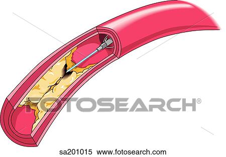 Stock Illustration - Clearing of plaque from a blood vessel utilizing a "clot buster".. Fotosearch
