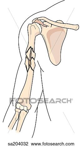 Comminuted (multiple) fracture of the humerus. View Large Illustration Drawing - Comminuted (multiple) fracture of the humerus.. Fotosearch