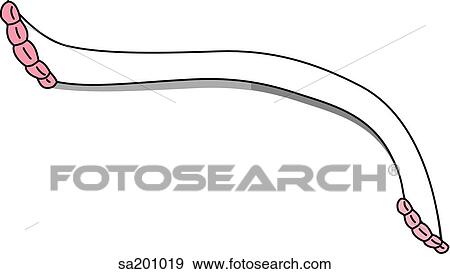 Stock Illustration - Coronary bypass. Left diversionary channel.. Fotosearch